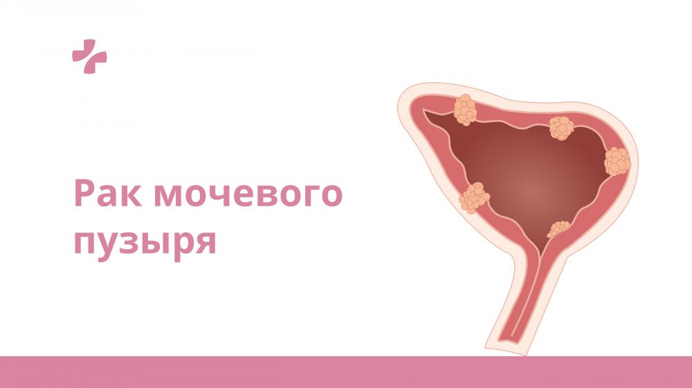 Причины цистита после интимной. Опухоль мочевого пузыря клиника. Классификация опухоли мочевого пузыря TNM.