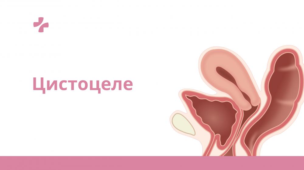 Заболевания мочевого пузыря: симптомы и лечение цистита у женщин