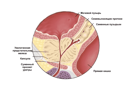 Аденома предстательной железы: симптомы и причины