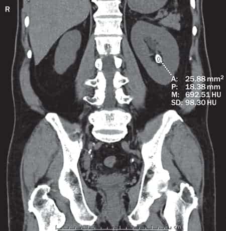 CTkidney stone.jpg