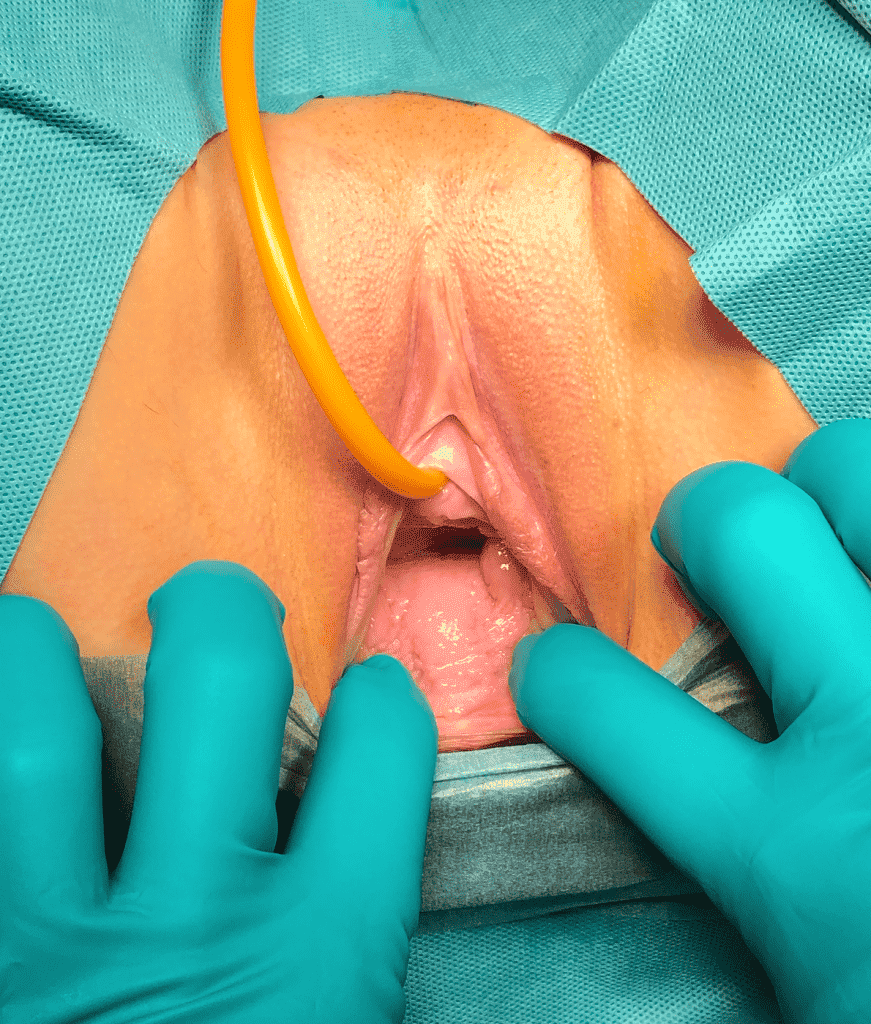 Увеличение половых губ гиалуроновой кислотой - цены в «СМ-Клиника»
