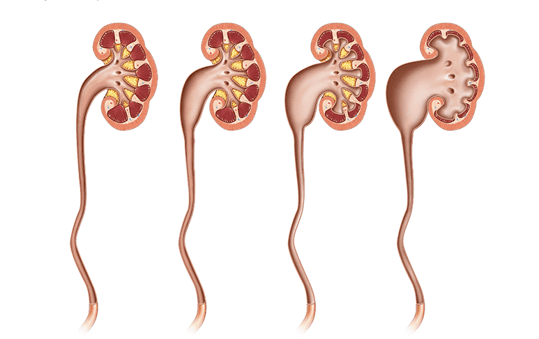 hydronephrosis-illustration.png